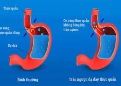 Dấu hiệu trào ngược dạ dày: Nhận biết sớm để bảo vệ hệ tiêu hóa