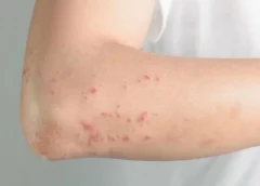Bị sởi kiêng gì? Hướng dẫn chăm sóc người bệnh sởi đúng cách tại nhà